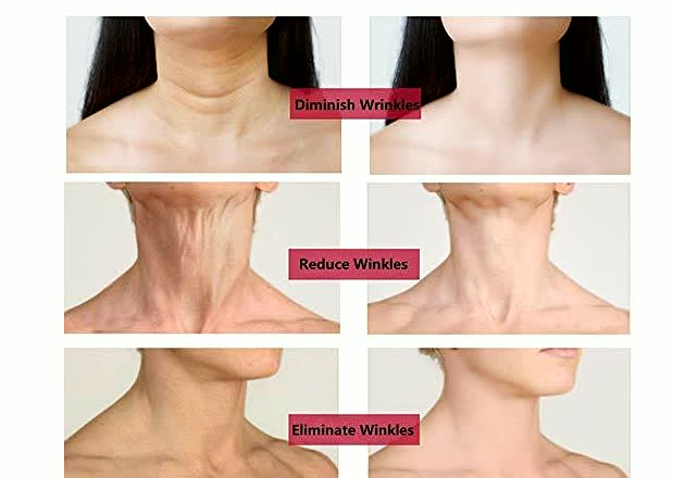 LYVA Neck Anti-Wrinkle Pad before after results